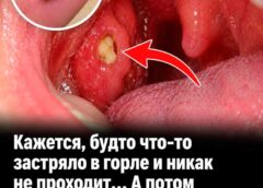 Белые комочки в горле: почему появляются пробки в миндалинах и как от них избавиться